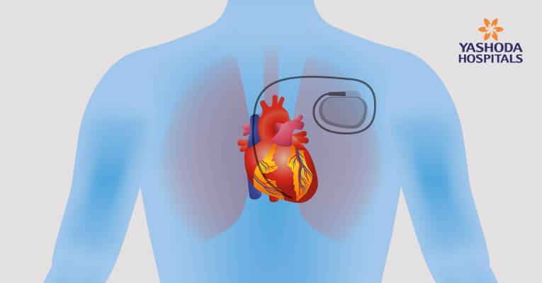 Living with a Pacemaker