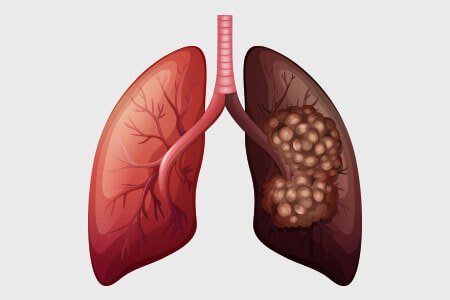 What is Lung cancer