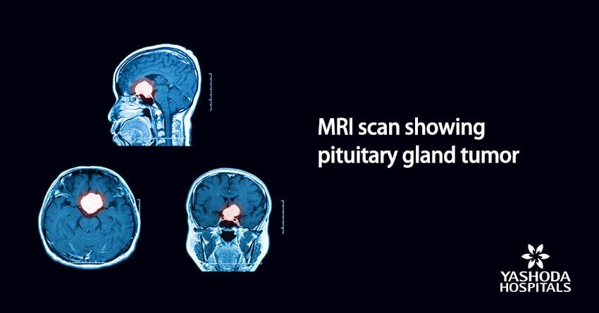 MRI scan showing pituitary gland tumor