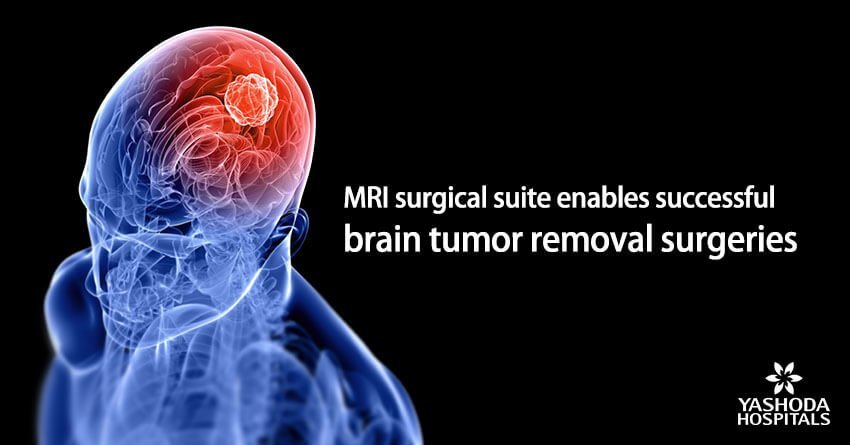 MRI surgical suite enables successful brain tumor removal surgeries