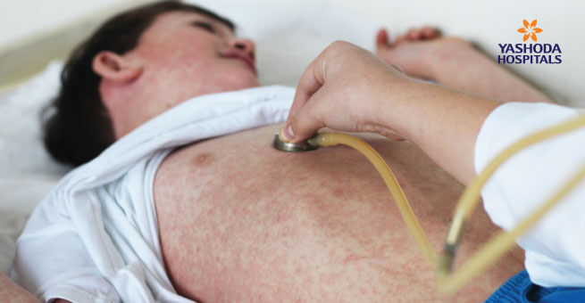 Measles spread in child
