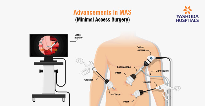 Minimal Access Surgery Blog1
