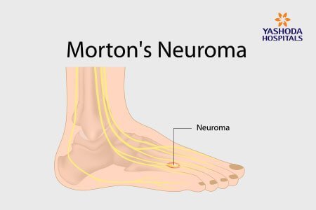 Morton's Neuroma: What is Morton's Neuroma, its Causes?