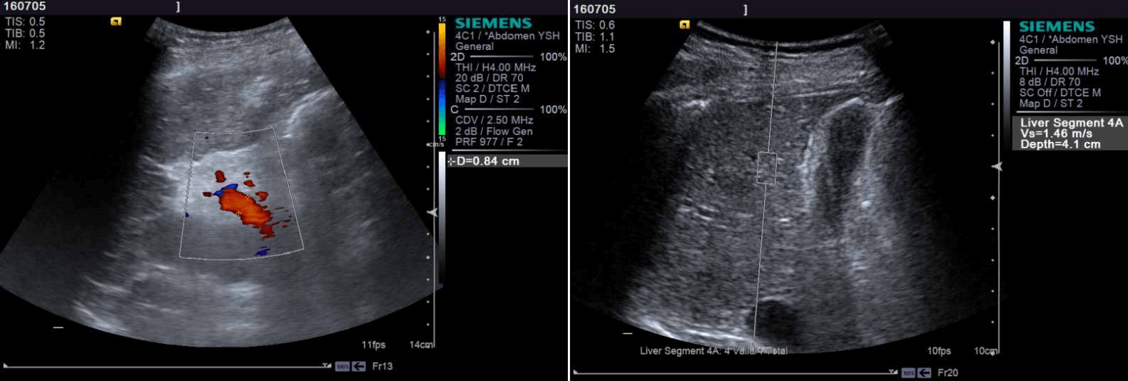  Normal liver stiffness in a young male patient with portal hypertension. Elastography helped rule out cirrhosis
