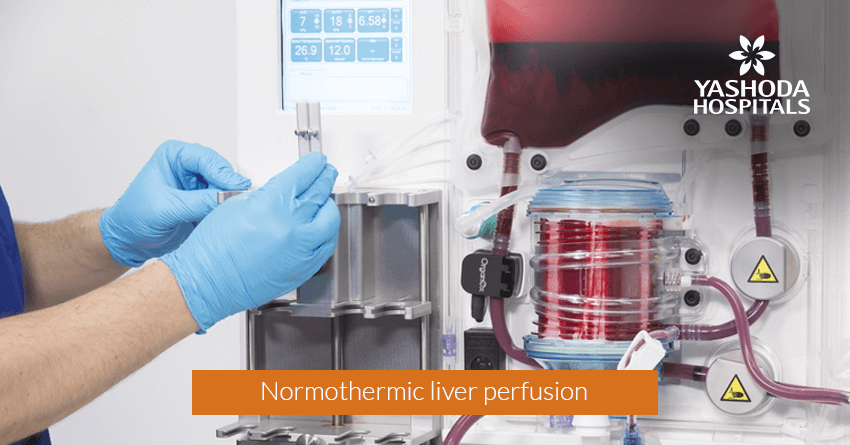 Normothermic liver perfusion
