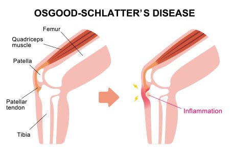 Osgood-Schlatter Disease and it's Causes