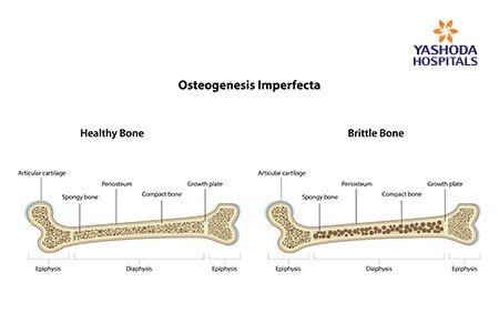 Osteogenesis imperfecta: What is Osteogenesis imperfecta, its Types and Causes?