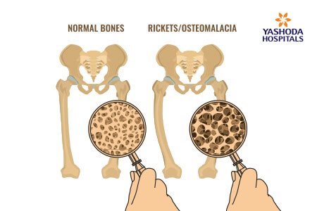Osteomalacia: What is Osteomalacia, its Causes?