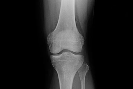 Osteonecrosis of the knee and it's Causes