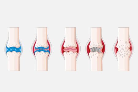 Symptoms, Risk Factors and Complications of Osteonecrosis of the knee