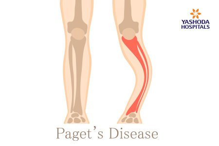 Paget's disease: What is Paget's disease, its Causes?