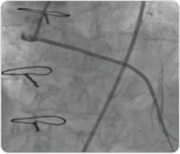 Percutaneous Coronary Intervention of A Diffusely Degenerated Saphenous Vein Graft