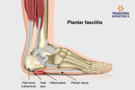 Plantar Fasciitis and Bone Spurs: What is Plantar Fasciitis and Bone Spurs, its Causes?