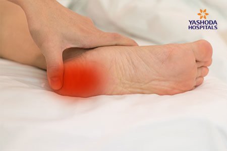 Plantar Fasciitis and Bone Spurs: Symptoms and Complications