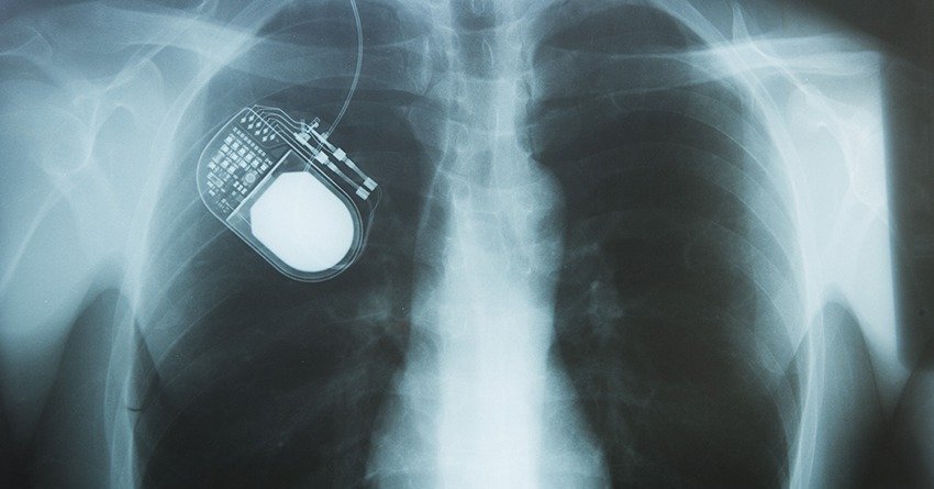 Pulse generator visible on X-ray