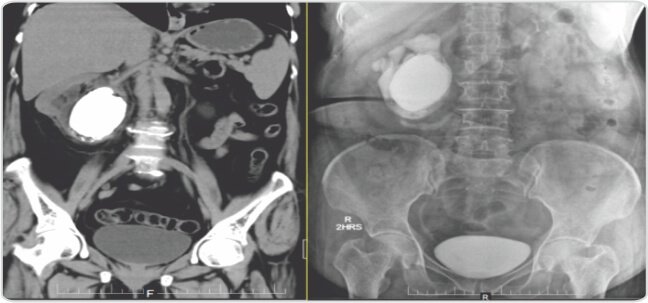 Giant Renal Pelvic Calculus Removed Laparoscopically  in Toto