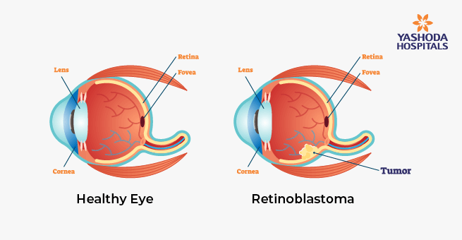 Retinoblastoma in Children_Body 1