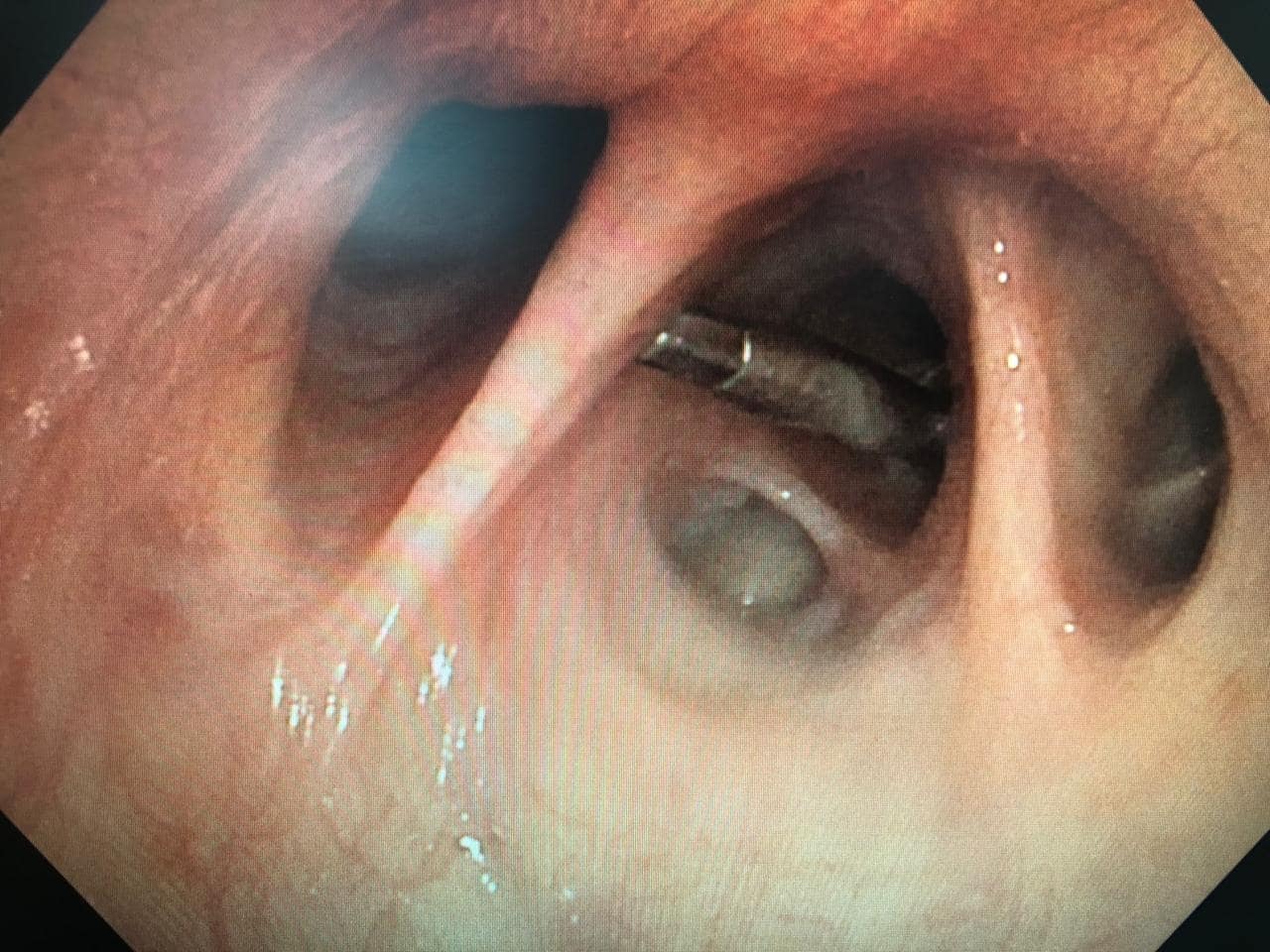 Right bronchoscopic