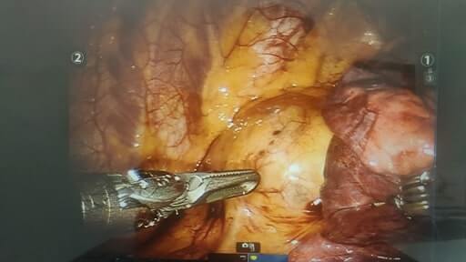 Robotic left mediastinal tumor excision