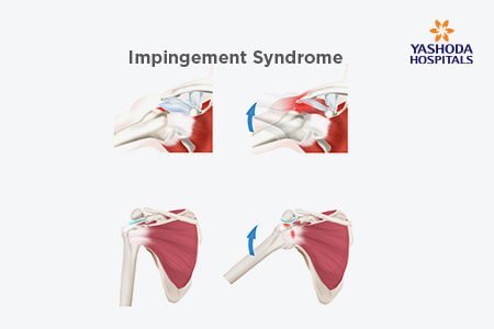 Shoulder Impingement: What is Shoulder Impingement, its Causes?