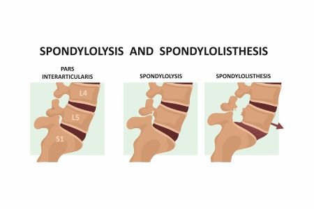 What is Spondylolysis and Spondylolisthesis