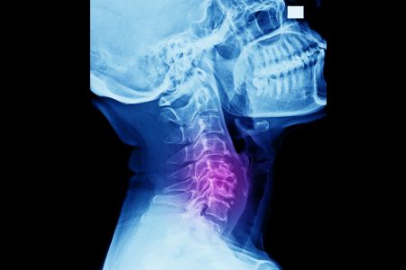 What is Cervical Spondylotic Myelopathy?