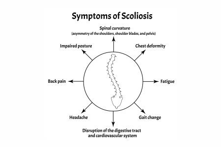 What are the symptoms of Scoliosis?