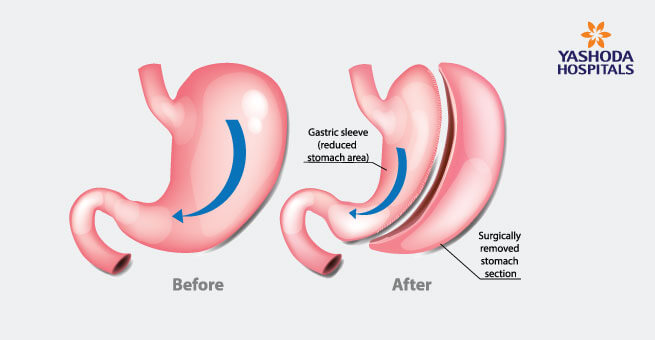 Sleev gastrectomy