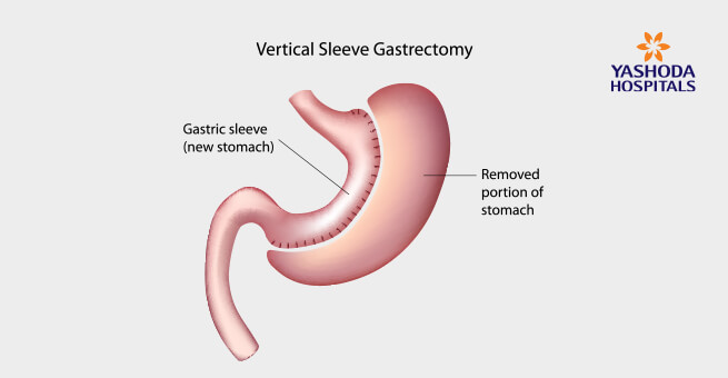 Sleeve Gastrectomy help in weight loss