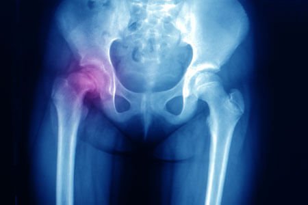 Symptoms and Complications of Slipped Capital Femoral Epiphysis