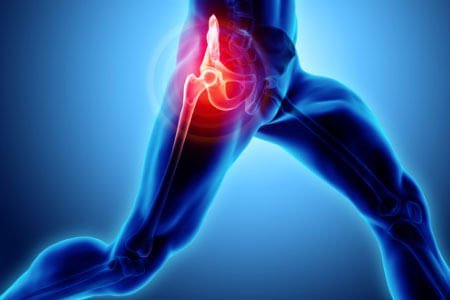 Symptoms, Risk Factors and Complications of Snapping Hip Syndrome