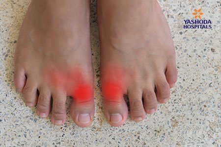 Stiff Big Toe (Hallux Rigidus): Symptoms and Complications