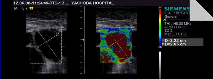 Strain Elastography of a breast cyst - soft in consistency, as indicated by red on the strain map.