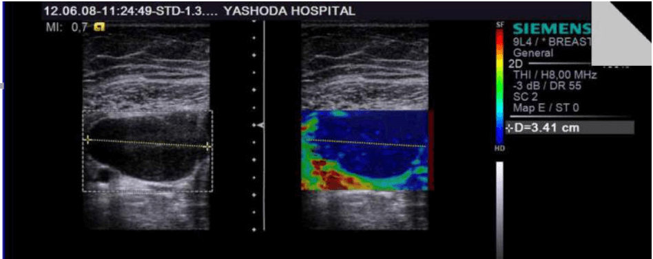 Strain Elastography of a firm to hard breast lesion: a fibroadenoma