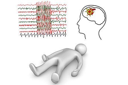 Epilepsy or Seizures