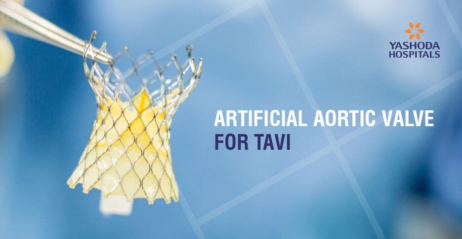 Transcatheter Aortic Valve Replacement (TAVR) for severe aortic valve stenosis