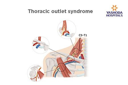 Thoracic Outlet Syndrome: What is Thoracic Outlet Syndrome, its Types and Causes?
