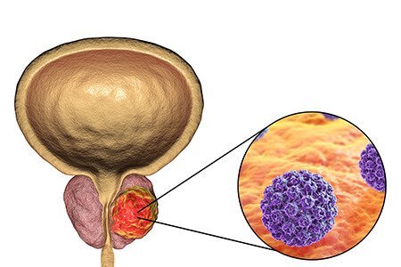How is prostate cancer treated