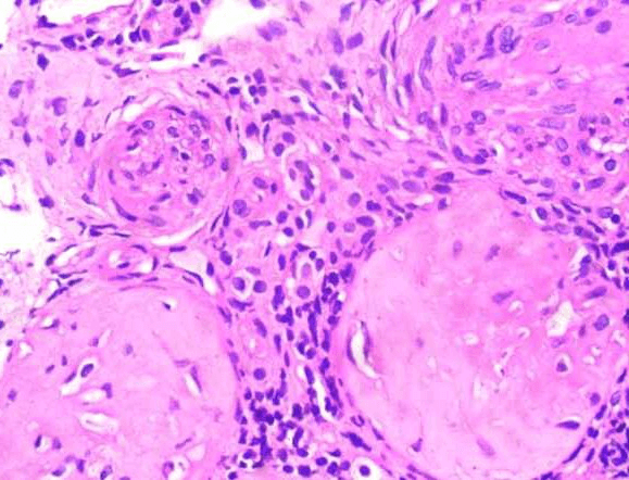 Two sclerosed glomeruli with an artery showing luminal occlusion due to fibrointimal hyperplasia