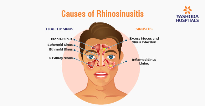 Understanding Rhinosinusitis1
