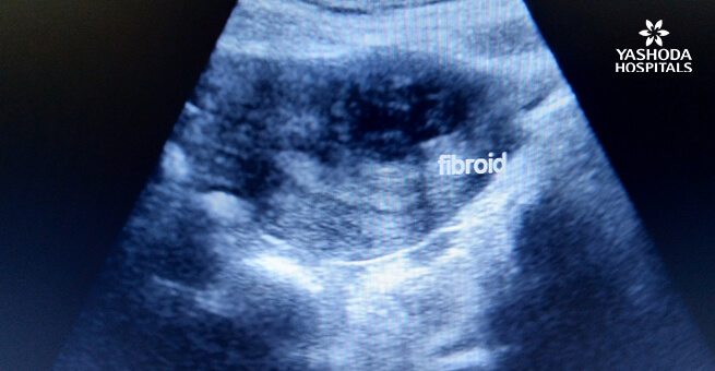 Uterine Fibroids diagnoses