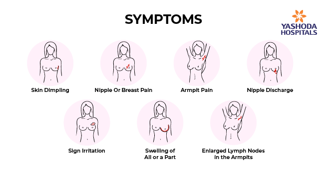 Warning signs and symptoms of breast cancer