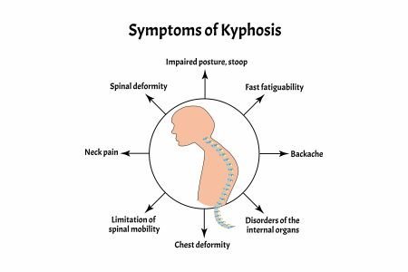 What are the symptoms of Kyphosis of the Spine