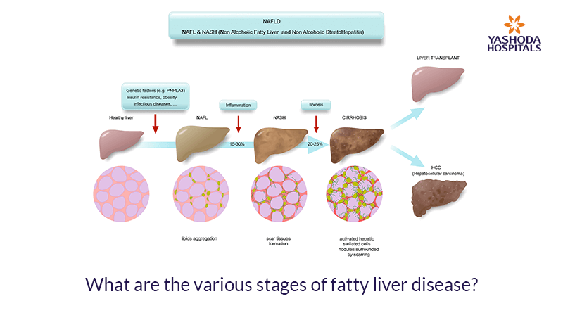 What are the various stages of fatty liver disease
