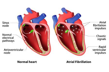 What-is-Atrial-Fibrillation