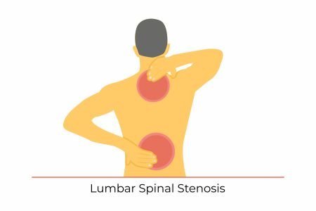 What are the causes of Lumbar Spinal Stenosis?