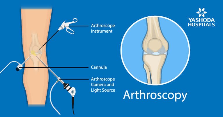 What is arthroscopic surgery