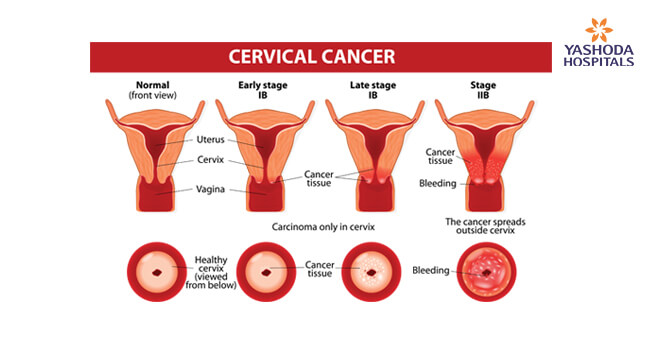 What is cervical cancer?