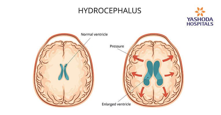 What is hydrocephalus