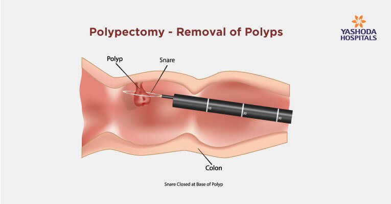 What is polypectomy procedure